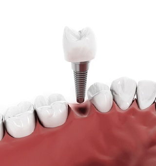 model of dental implant