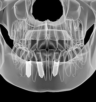 scan of dental implant