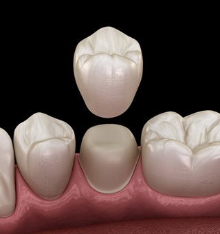dental crown fitting down on tooth