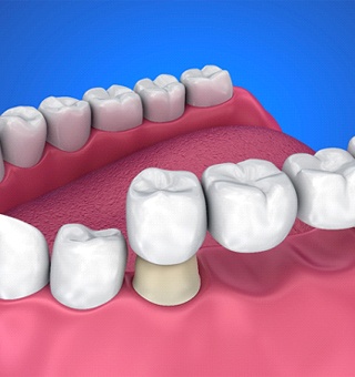 dental bridge attached to abutments