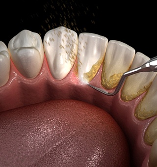 scaler removing plaque and tartar from teeth