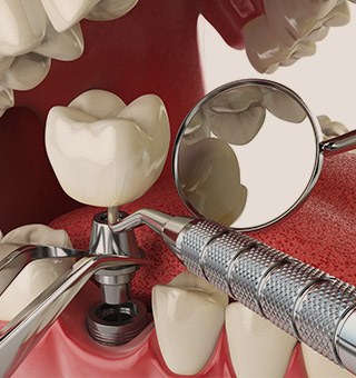 Animation of implant supported dental crown placement