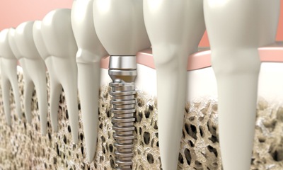 single tooth implant