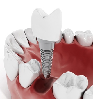 model of dental implant