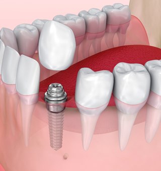 single tooth implant