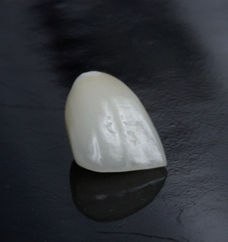 Porcelain veneers