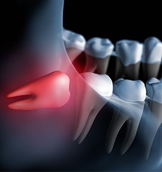 Animation of impacted wisdom tooth